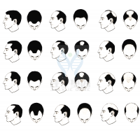 【腾博会官网基因检测】过早<font color='red'>脱发</font>、掉发太多怎么办？你的方法可能是错的！